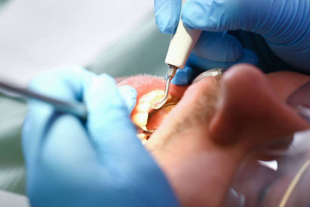 Best Emergency Root Canal Treatment in Solomons, MD