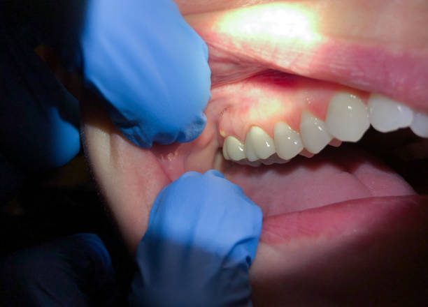 Best Emergency Dental Services for Seniors in Solomons, MD