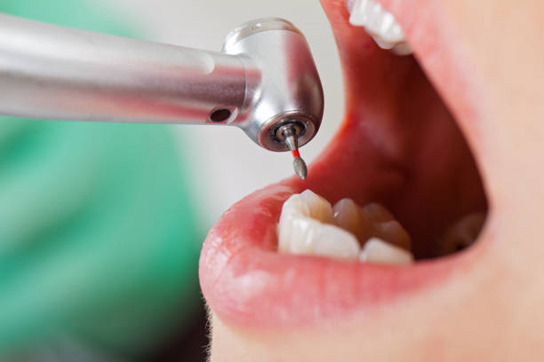 Best Emergency Dental Care for Abscessed Tooth in Solomons, MD